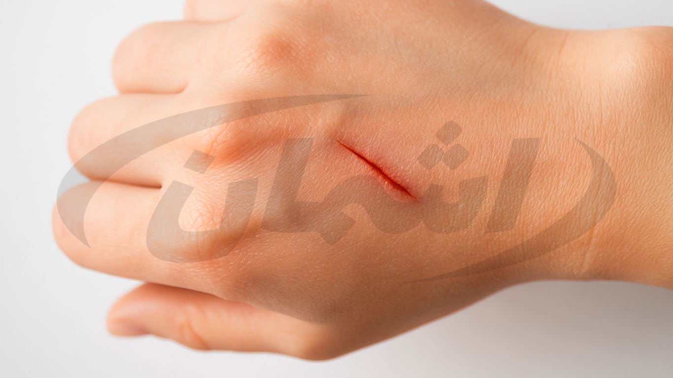 راهنمای دقیق استفاده از اتانول برای ترمیم زخمها و نکات ایمنی|اشمان